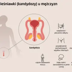 Ilustracja przedstawia objawy kandydozy u mężczyzn, w tym zaczerwienienie i obrzęk narządów płciowych, co może wskazywać na grzybicę penisa.