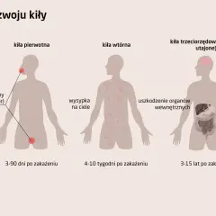 Grafika pokazuje stadia rozwoju kiły. Pierwsze stadium to wrzód weneryczny, drugie to wysypka na ciele, a trzecie to uszkodzenie organów wewnętrznych. Objawy kiły u mężczyzn mogą być różne w zależności od stadium.