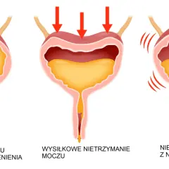 Ilustracja pokazuje trzy rodzaje nietrzymania moczu: przepełnienie, wysiłkowe i z nagłymi parciami.