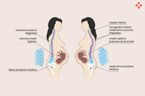 Ból na dole pleców w ciąży w 1 trymestrze. Ilustracja pokazuje zmiany w kręgosłupie i miednicy kobiety w ciąży, które mogą powodować dyskomfort.