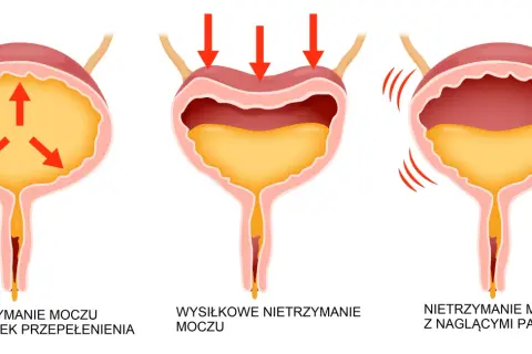 Ilustracja pokazuje trzy rodzaje nietrzymania moczu: przepełnienie, wysiłkowe i z nagłymi parciami.