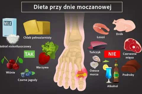Dieta przy dnie moczanowej: TAK - nabiał, chleb, warzywa, owoce. NIE - drób, ryby, czerwone mięso, podroby, owoce morza, alkohol. Czego nie jeść przy dnie moczanowej.