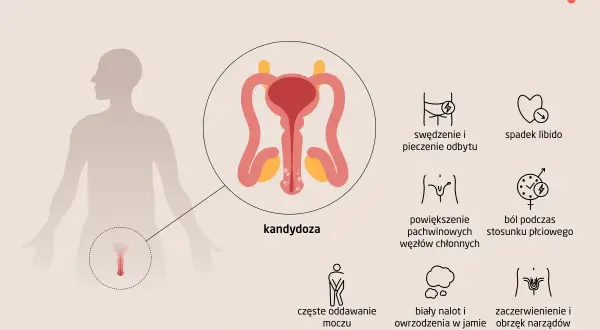 Ilustracja przedstawia objawy kandydozy u mężczyzn, w tym zaczerwienienie i obrzęk narządów płciowych, co może wskazywać na grzybicę penisa.