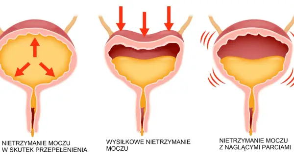 Ilustracja pokazuje trzy rodzaje nietrzymania moczu: przepełnienie, wysiłkowe i z nagłymi parciami.