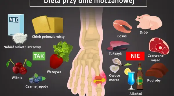 Dieta przy dnie moczanowej: TAK - nabiał, chleb, warzywa, owoce. NIE - drób, ryby, czerwone mięso, podroby, owoce morza, alkohol. Czego nie jeść przy dnie moczanowej.
