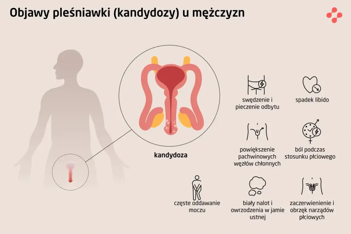 Ilustracja przedstawia objawy kandydozy u mężczyzn, w tym zaczerwienienie i obrzęk narządów płciowych, co może wskazywać na grzybicę penisa.