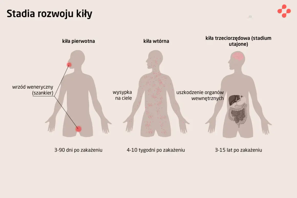 Grafika pokazuje stadia rozwoju kiły. Pierwsze stadium to wrzód weneryczny, drugie to wysypka na ciele, a trzecie to uszkodzenie organów wewnętrznych. Objawy kiły u mężczyzn mogą być różne w zależności od stadium.