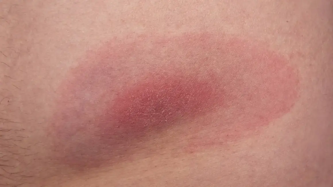 Rumień wędrujący, jeden z objawów ugryzienia kleszcza, rozszerza się na skórze.