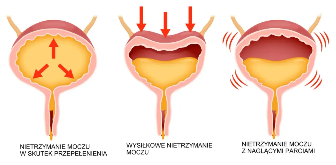 Ilustracja pokazuje trzy rodzaje nietrzymania moczu: przepełnienie, wysiłkowe i z nagłymi parciami.
