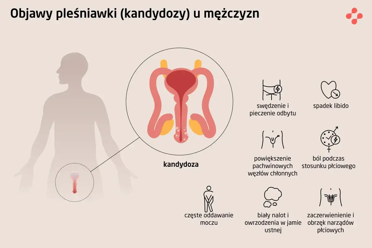 Ilustracja przedstawia objawy kandydozy u mężczyzn, w tym zaczerwienienie i obrzęk narząd&oacute;w płciowych, co może wskazywać na grzybicę penisa.