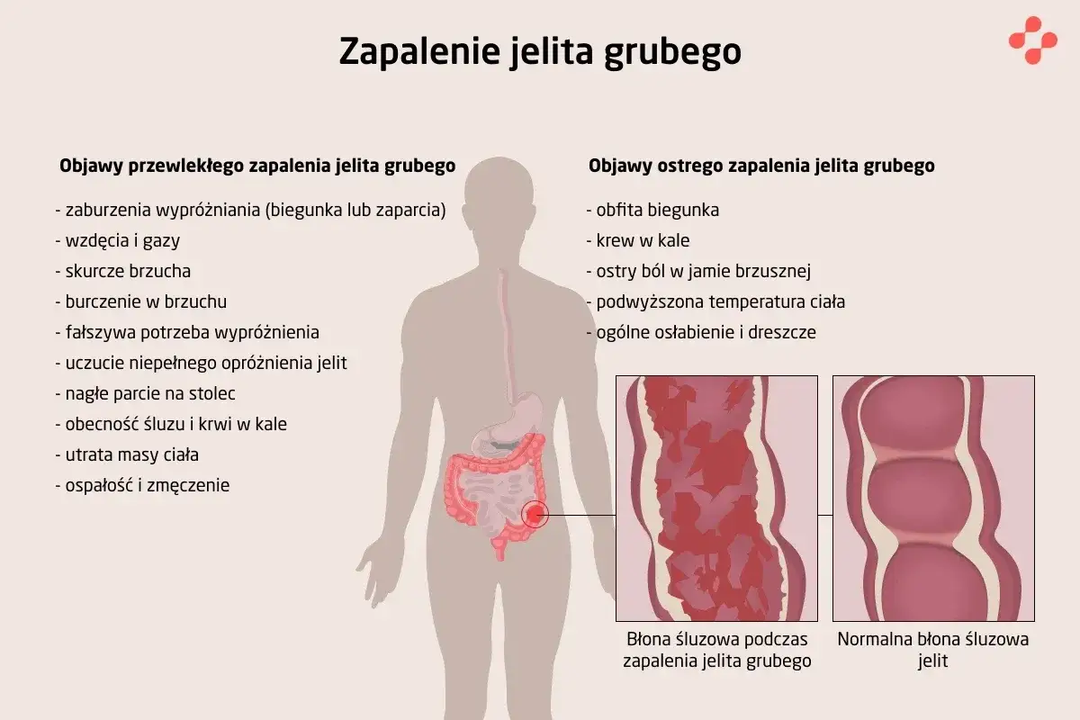 Ilustracja przedstawia objawy zapalenia jelita grubego: przewlekłe i ostre. Wymienione symptomy to m.in. biegunka, krew w kale, bóle brzucha, gorączka.