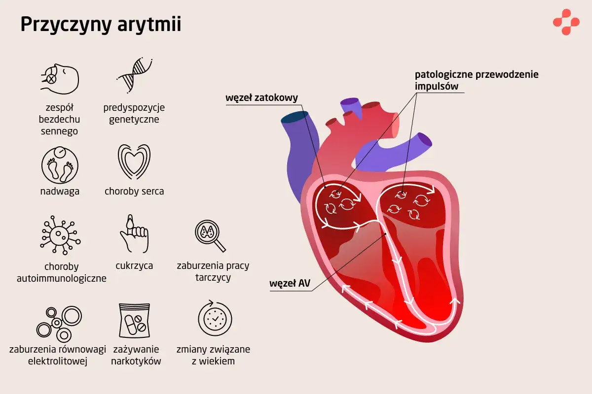 Ilustracja przedstawia przyczyny arytmii, w tym problemy z sercem, które mogą prowadzić do mocnego bicia serca.