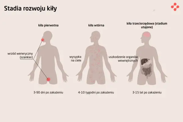 Grafika pokazuje stadia rozwoju kiły. Pierwsze stadium to wrzód weneryczny, drugie to wysypka na ciele, a trzecie to uszkodzenie organów wewnętrznych. Objawy kiły u mężczyzn mogą być różne w zależności od stadium.