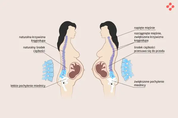 Ból na dole pleców w ciąży w 1 trymestrze. Ilustracja pokazuje zmiany w kręgosłupie i miednicy kobiety w ciąży, które mogą powodować dyskomfort.