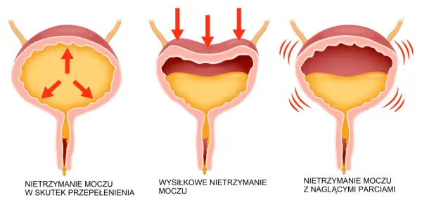 Ilustracja pokazuje trzy rodzaje nietrzymania moczu: przepełnienie, wysiłkowe i z nagłymi parciami.